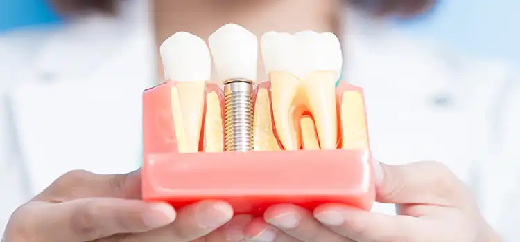 Dental Implants | Implant Technologies with Types, and Procedures