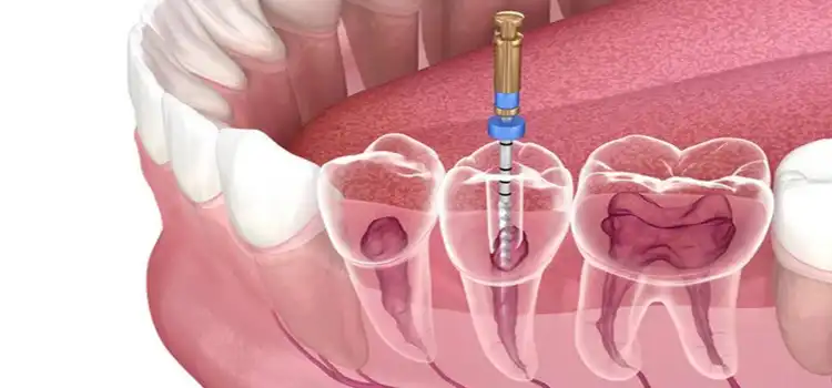 Technological Advancements in Root Canal Disinfection